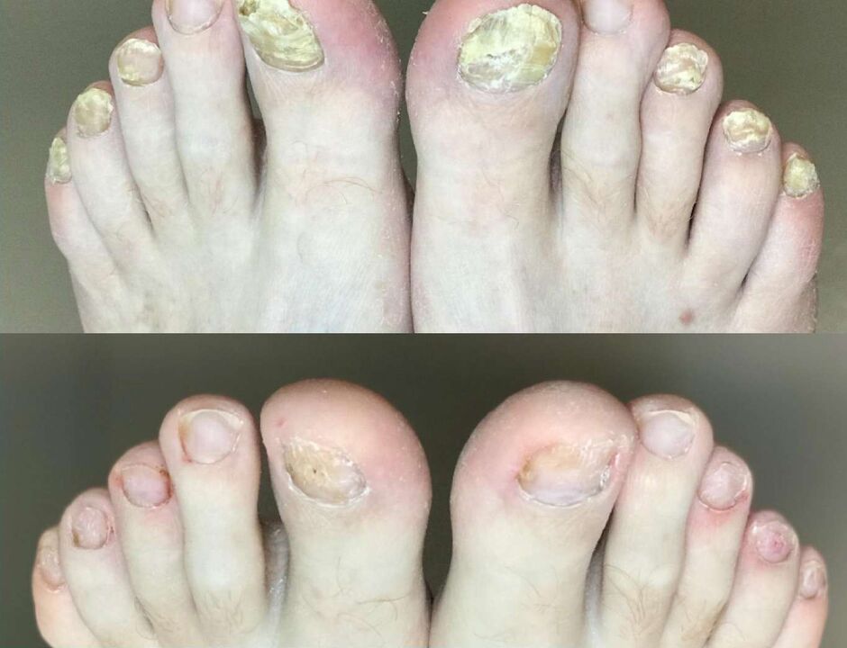 Antes e depois do tratamento, o fungo Promisil Cream