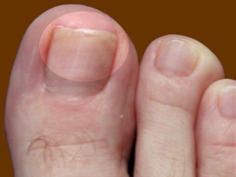 Os primeiros sinais de fungo das unhas