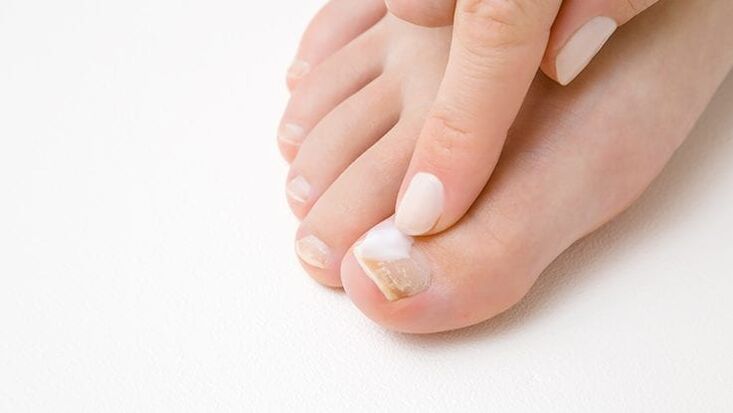 tipo de fungo nas unhas