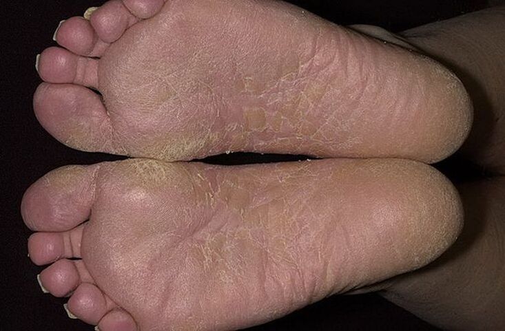 Pele seca e escamosa nos pés é sinal de micose escamosa
