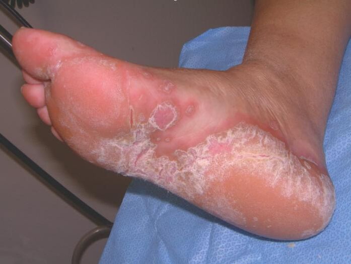 Pé afetado por infecção fúngica