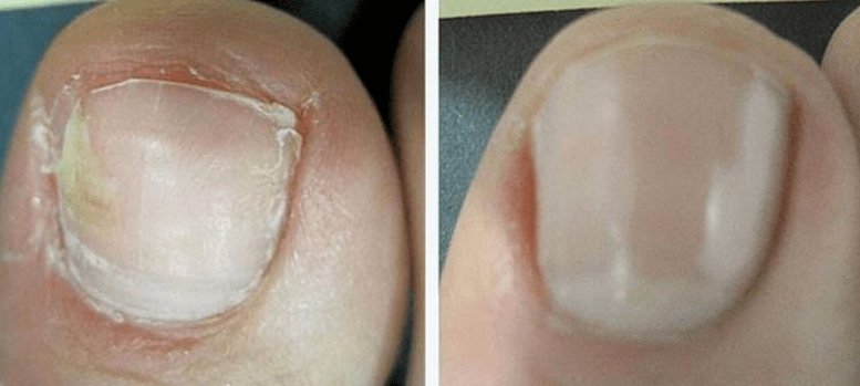 Unha antes e depois do tratamento de fungos