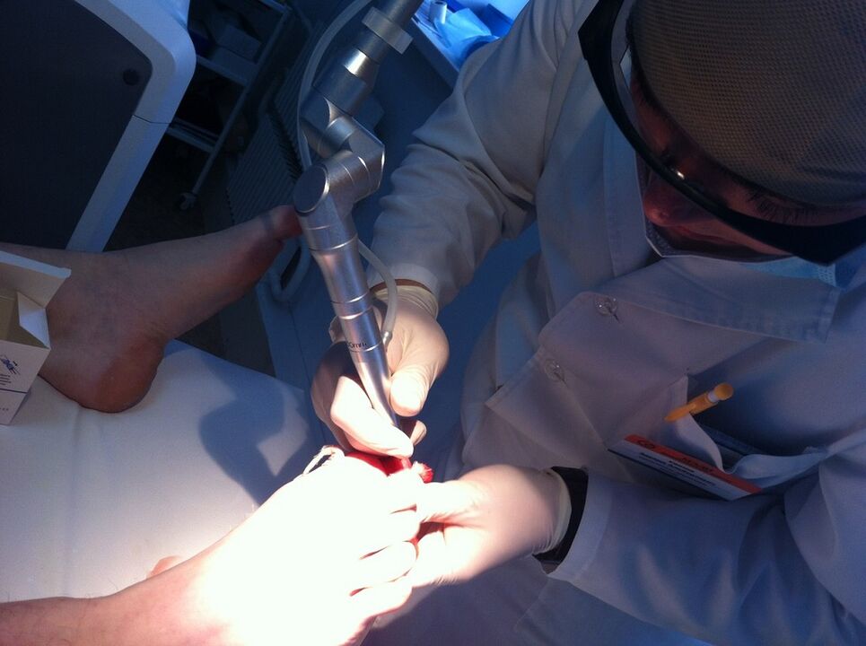 Tratamento a laser de micosis